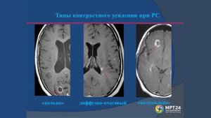 Демиелинизирующие заболевания на МРТ