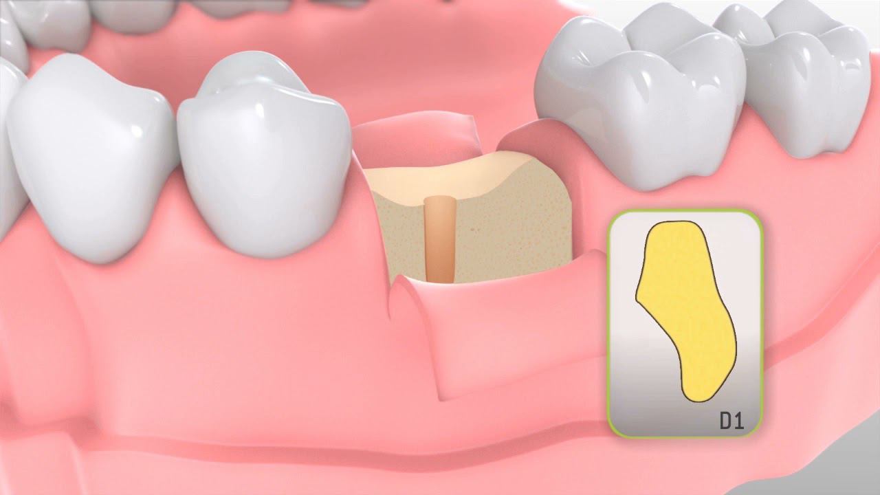 Implantmed SI-1023 функция нарезания резьбы. www.apexdental.ru