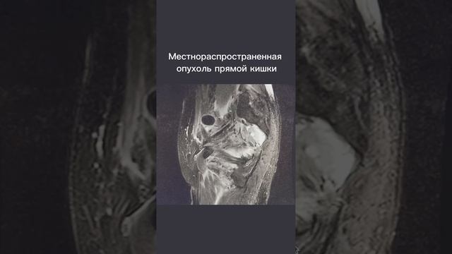 Местнораспространенная опухоль прямой кишки