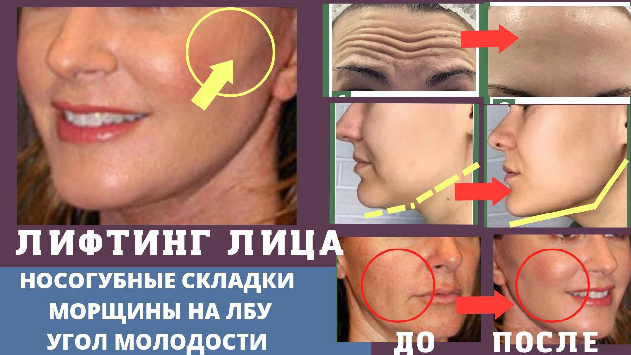 ЛИФТИНГ ЛИЦА Носогубные Морщины Морщины на Лбу Угол Молодости.mp4