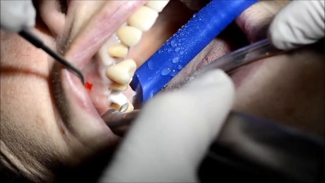 Подготовка к оттиску циркониевых абатментов AWI смотреть онлайн