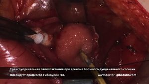 Трансдуоденальная папиллэктомия при аденоме большого дуоденального сосочка
