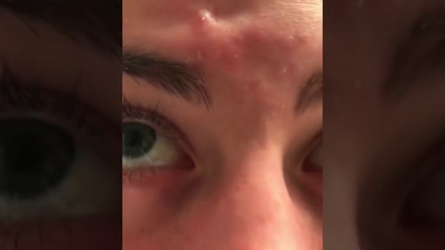 Выдавливание прыща на лбу смотреть онлайн