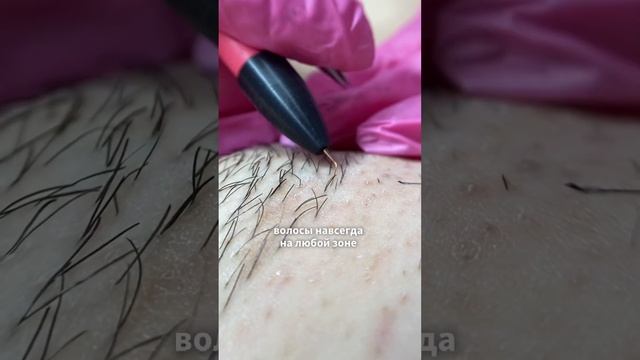 Электроэпиляцию делала даже Мэрилин Монро, а ты всё ещё не решаешься) #электроэпиляциямосква