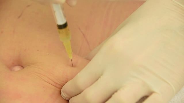 Коррекция локальных жировых отложений / Liposculpture mesotherapy