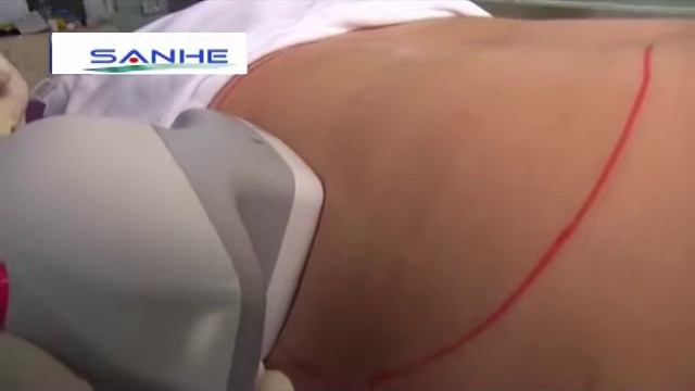 Аппаратный вакуумно-роликовый массаж, лимфодренажный массаж