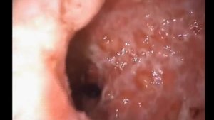 Неспецифический язвенный колит