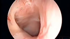 Гипертрофия трубных валиков после операции.mp4