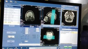 Venography MRI scan Protocol, Live Demo on GE 1.5 Tesla -  MRV Brain - Easy Technique.