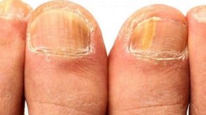 Неумывакин: бактерии,вирусы и грибок уйдут вместе с болезнью! Грибок снаружи и внутри исчезнет !!!