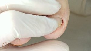 Hallux cleaning | 1st video @podologiaintegral