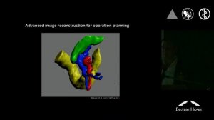 Total Mesocolic Excision for Colon Cancer  Evidence Based Data, Tips&Trics Lap Procedure