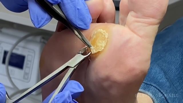 Удаление огромной мозоли | Ольга Палёнова | Level_Up_Nails смотреть онлайн