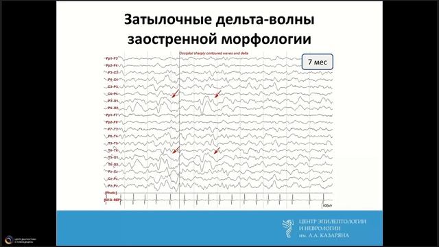Троицкий А.А. Физиологические паттерны на Видео ЭЭГ смотреть онлайн