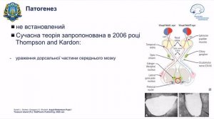 синдром Аргайля Робертсона