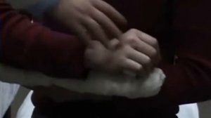 наложение шины при переломе кисти