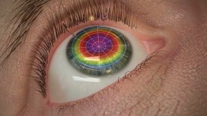 Femto Super LASIK