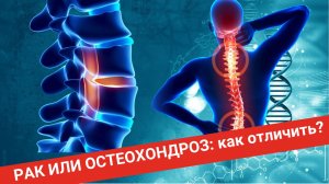 РАК И ОСТЕОХОНДРОЗ: как отличить?