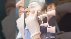 Наполнение скул филлером.Fillerle yanaq dolqusu