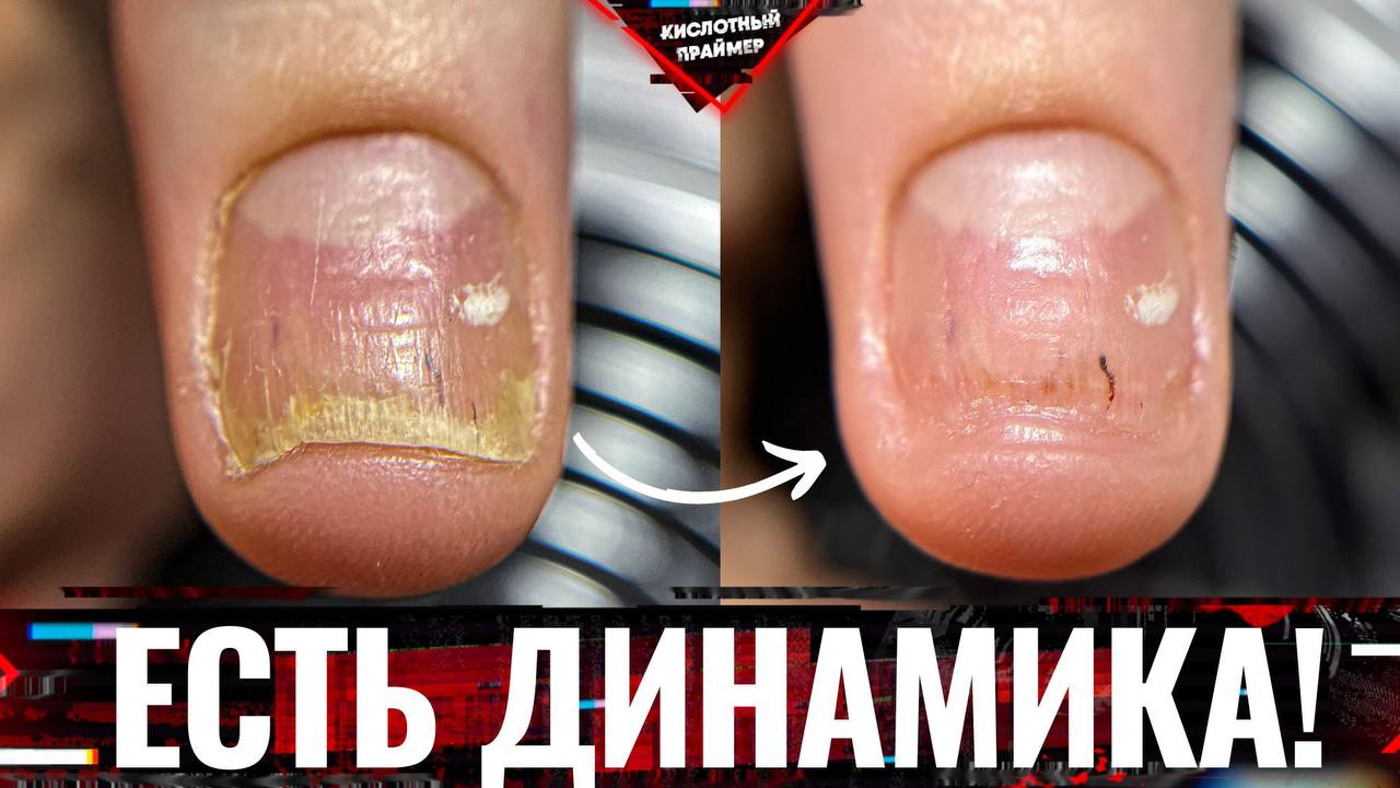 ?ИСТОРИЯ ОДНОГО НОГТЯ..? СНОВА ОНИХОЛИЗИС ногтей на руках?  Вторая зачистка