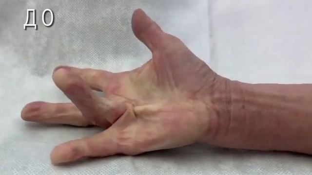 Контрактура Дюпюитрена смотреть онлайн