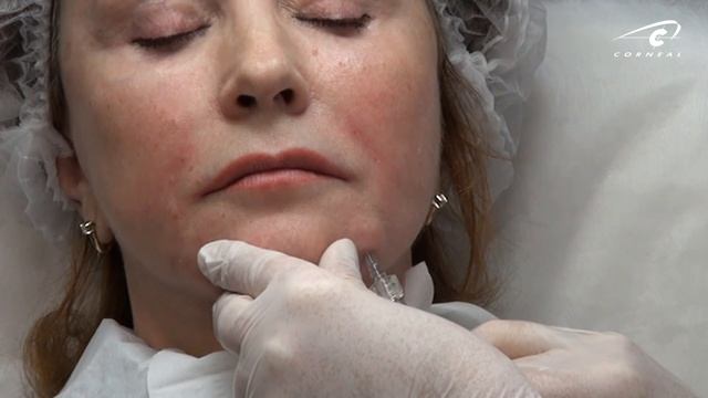 Обучение контурной пластике. Деликатная и естественная коррекция филлерами Princess смотреть онлайн