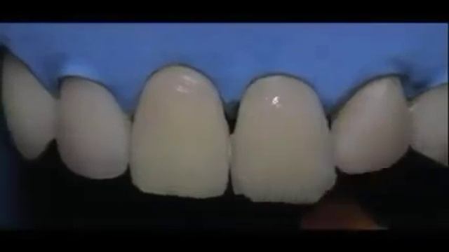 Композитные виниры