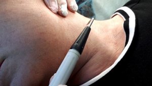 Удаляем папилломы электрокоагуляцией