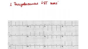 Причины депрессии сегмента ST? Как их отличать друг от друга? Дифференциальная диагностика.