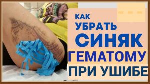 ПЕРВАЯ ПОМОЩЬ ПРИ УШИБЕ ССАДИНЕ ГЕМАТОМЕ