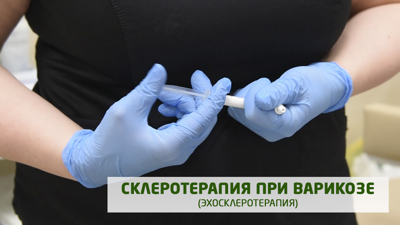 Склеротерапия при варикозе