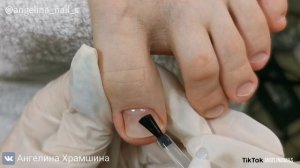 ПРОТЕЗИРОВАНИЕ АКРИЛОМ / вросший ноготь / восстанавливаем углы и боковые стенки / педикюр подростку