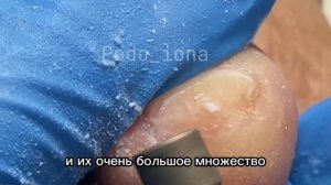 Зачистка грибкового ногтя. #подологмосква #грибок #педикюр #подология #грибокногтей #курсыпедикюра