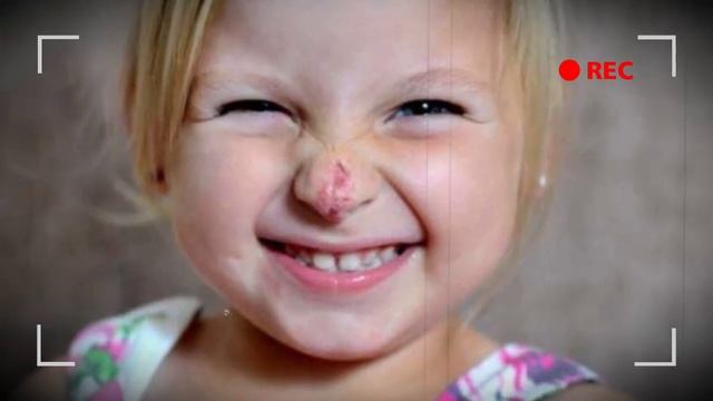 Все смеялись над ней! Как спустя 3 года выглядит дeвoчкa, которая родилась с «клоунским» носом смотреть онлайн