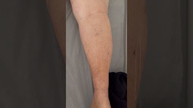 Тромбоз глубоких вен. Узи сосудов. Варикозное расширение вен. Узи вен. Флеболог Москва. Флеболог смотреть онлайн