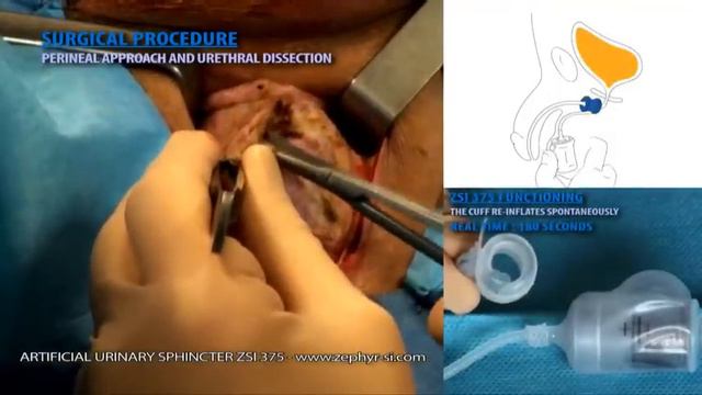 Artificial Urinary Sphincter SURGERY  Treatment For Male Severe Incontinence