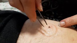 Удаление клеща в домашних условиях