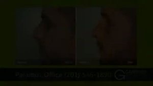 Rhinoplasty Reviews New Jersey | Gartner Plastic Surgery
