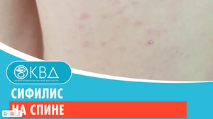 ? Сифилис на спине. Клинический случай №402