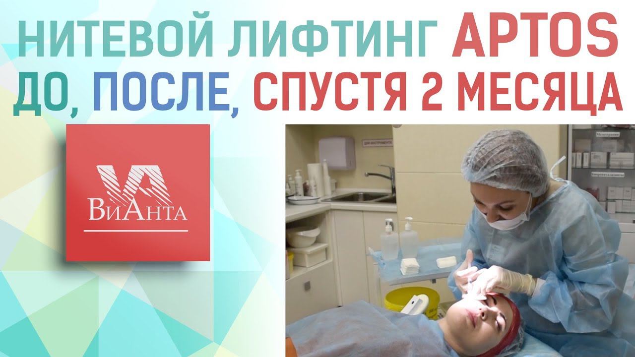Нитевой лифтинг АПТОС (APTOS). Клиника "ВиАнта", Курск