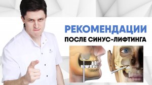 Рекомендации после операции синус-лифтинг (Sinus-lift) [ открытый и закрытый синус-лифтинг ].