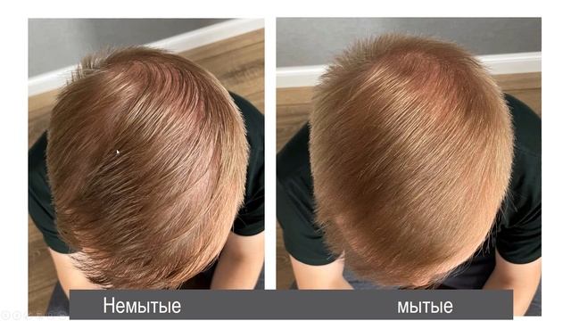 1 ГОД И 9 МЕСЯЦЕВ ПОСЛЕ ПЕРЕСАДКИ ВОЛОС. ОТЧЕТ. смотреть онлайн