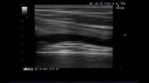 Синовит коленного сустава