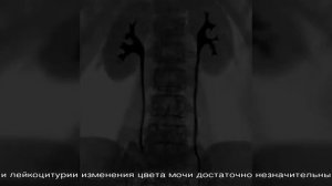 Песок в моче