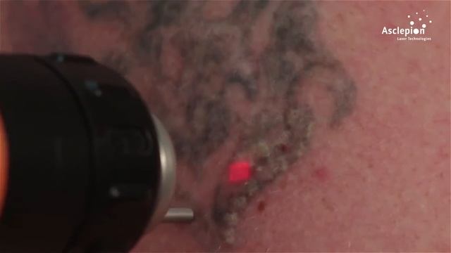 Удаление татуировок на TattooStar Effect от Asclepion смотреть онлайн