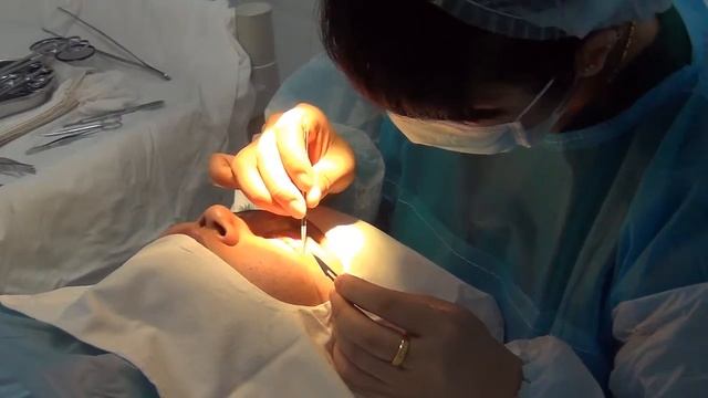 Лечение в Китае. Подтяжка век. Снимают нити в клинике "Евроазия" смотреть онлайн