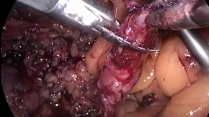 Complicated laparoscopic pyelolithotomy (UPJ rupture)   Лапароскопическая пиелолитотомия