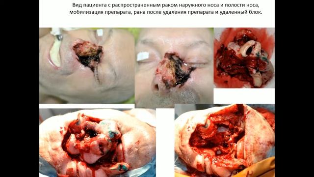 Современные подходы к лечению челюстно-лицевой травмы и опухолей челюстно-лицевой локализации смотреть онлайн