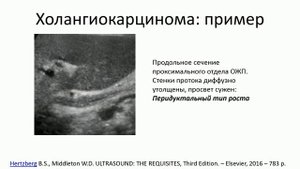Эхосемиотика структурных изменений желчного пузыря и желчных путей. Часть 2