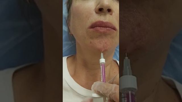 АирисКом студенты учатся: изменения формы подбородка филлером.